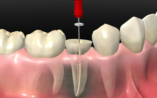 Dental-Assistance-servizi-endodonzia