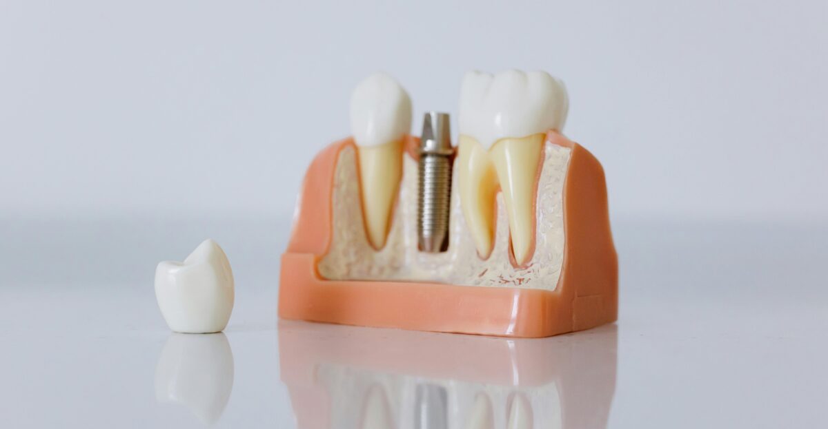 Dental-Assistance-Breglia-notizie-implantologia-1200x623.jpg