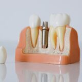 Dental-Assistance-Breglia-notizie-implantologia